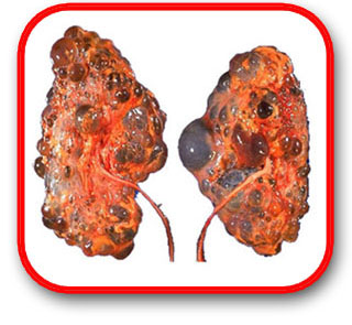 Gout Kidney Failed